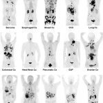 190616_positron emission tomography_002