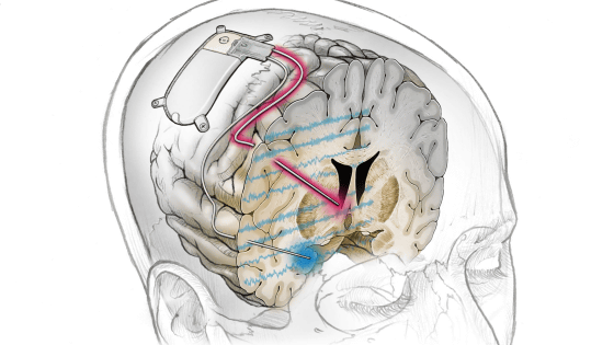 Treating Severe Depression with On-Demand Brain Stimulation